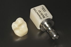 Zahnersatz in einer Sitzung